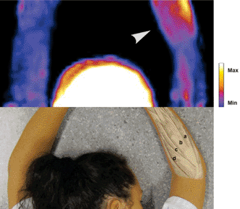 Imagen: TEP del receptor radioligando NK1 [11C] GR205171en un individuo (Fotografía cortesía de PLOS ONE).